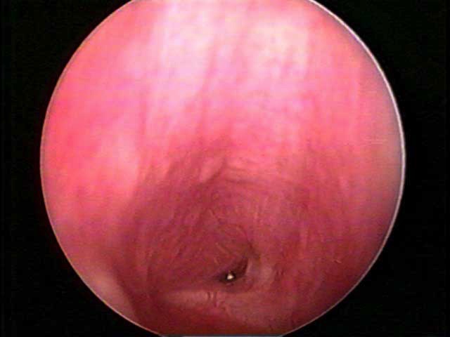 Estenosis Traqueal Cervical